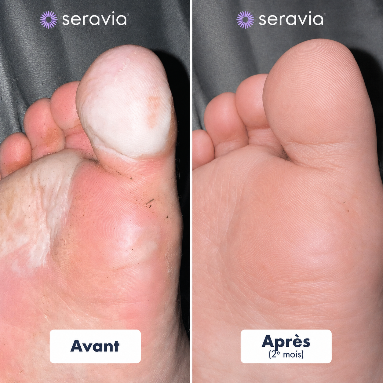 Stylo antifongique Seravia